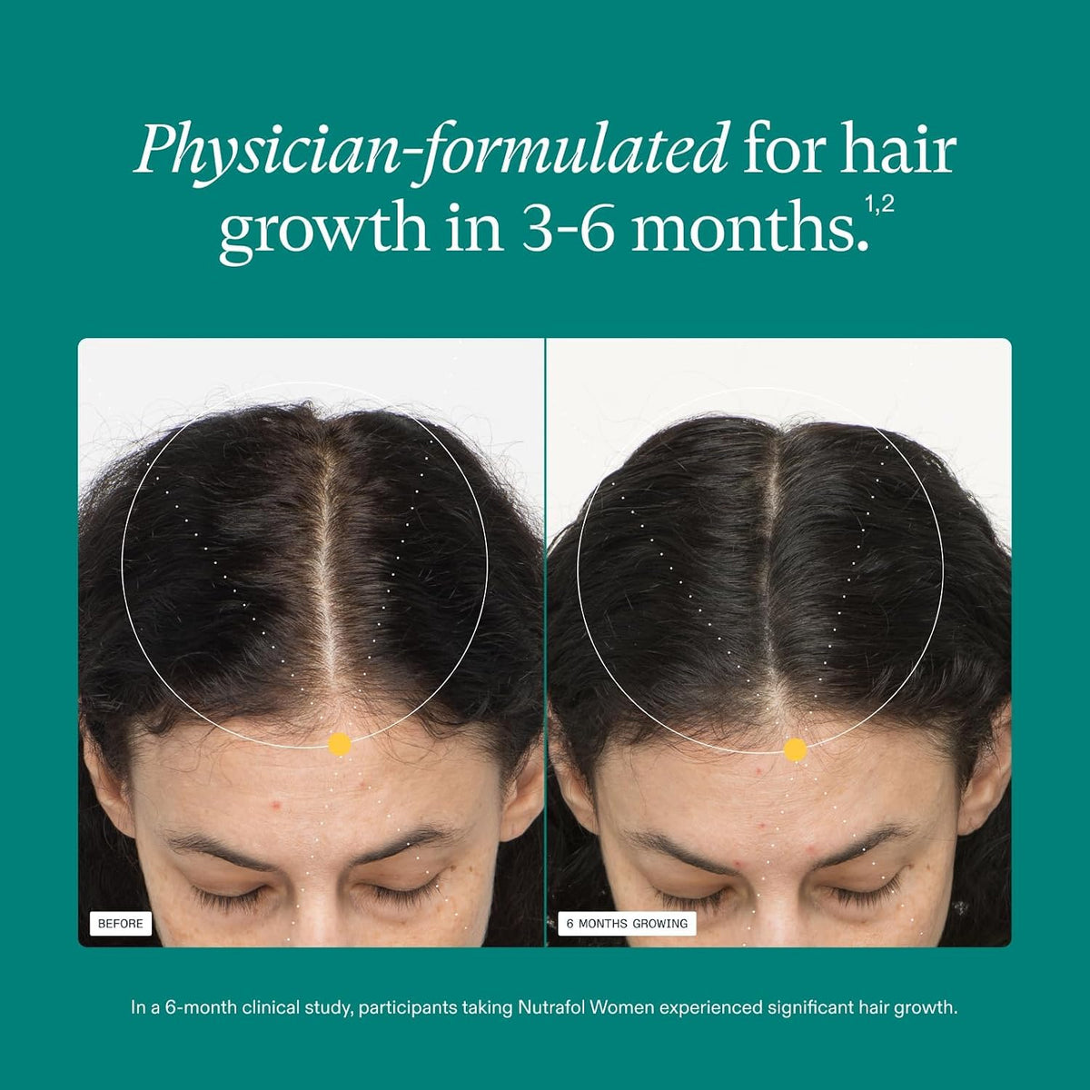 Nutrafol Women's Hair Growth Supplements, Ages 18-44, Clinically Tested for Visibly Thicker and Stronger Hair, Dermatologist Recommended - 1 Month Supply